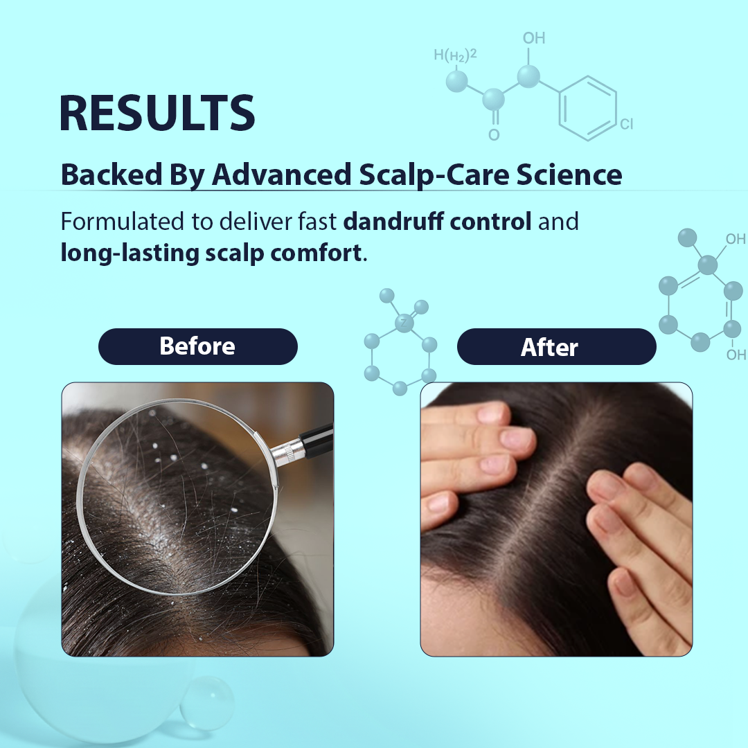 Before and after comparison of scalp care product with dandruff on a blue background.