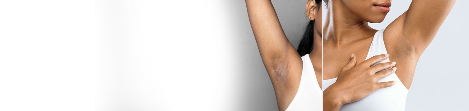 Underarms Lightening