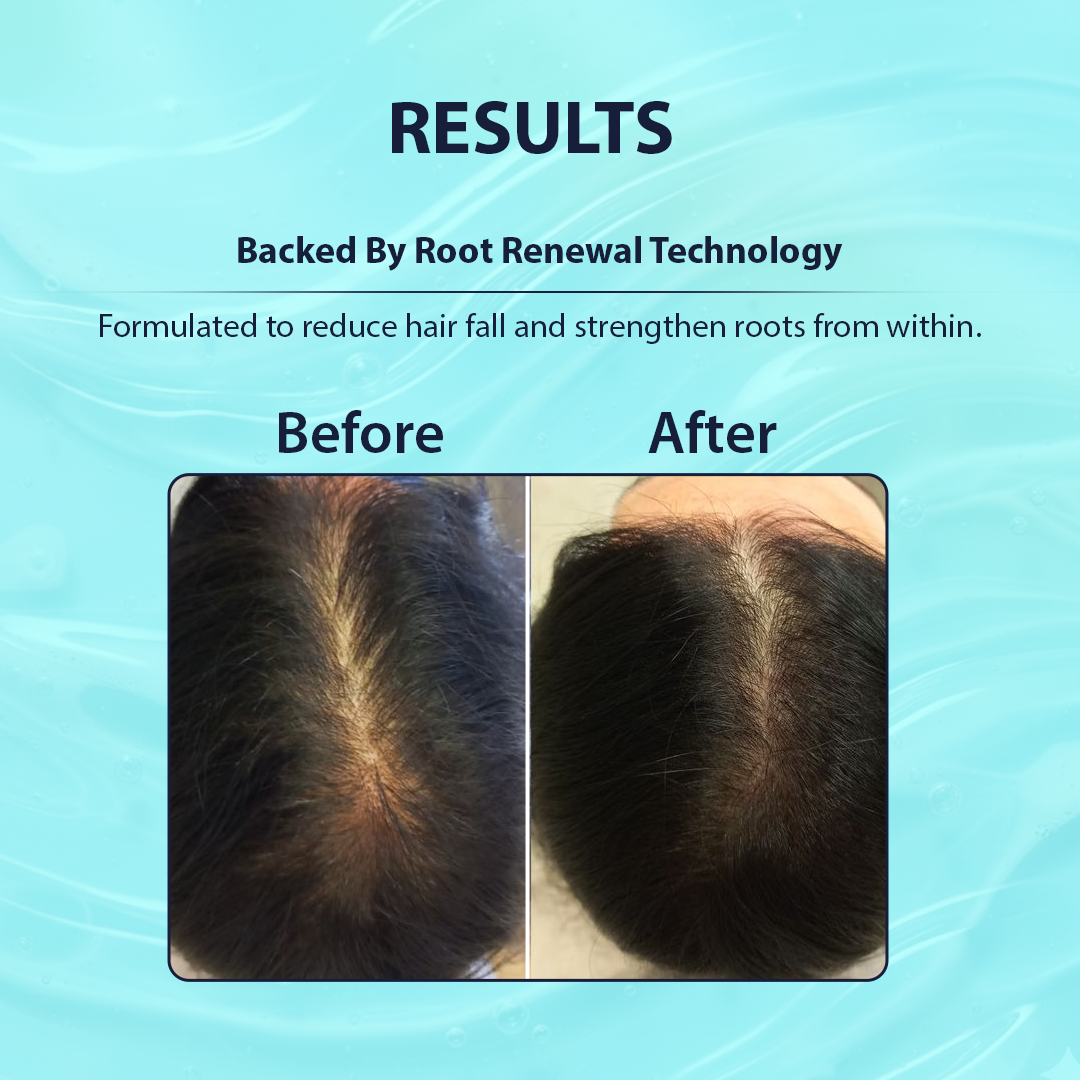 Before and after comparison of hair thickness with text about root renewal technology on a blue background.